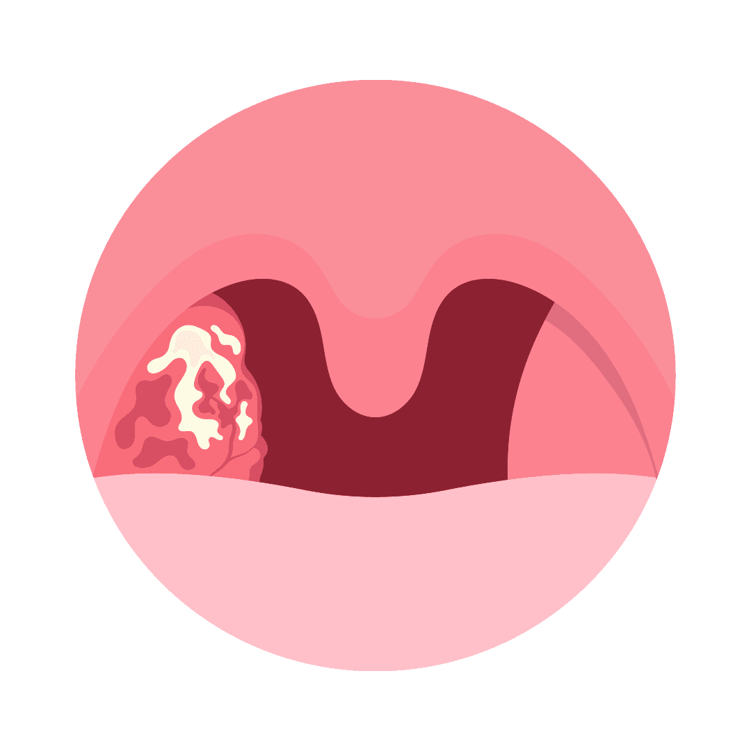 儿童腺样体