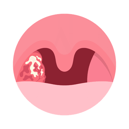 儿童腺样体